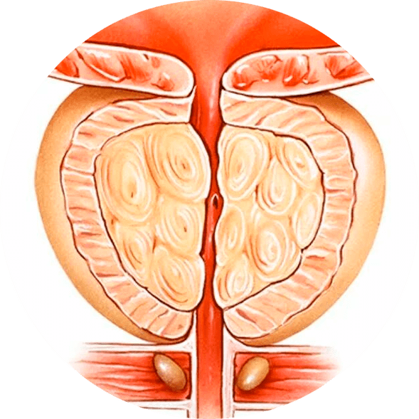 Consequences of untreated prostatitis