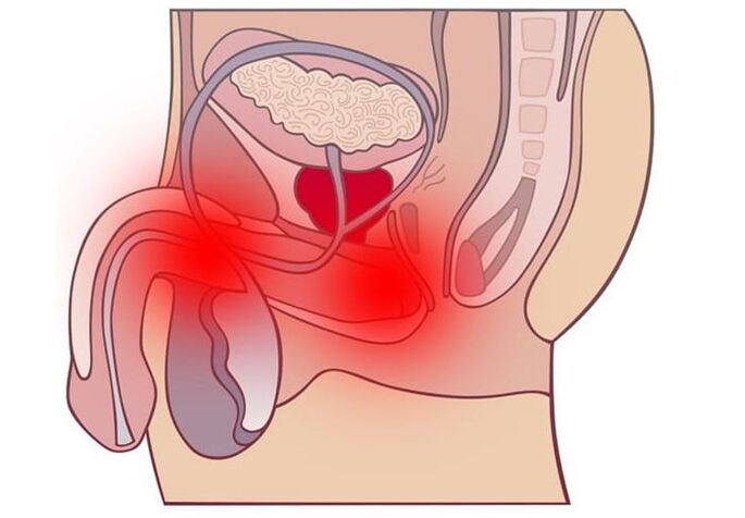 Methods of treatment of prostatitis