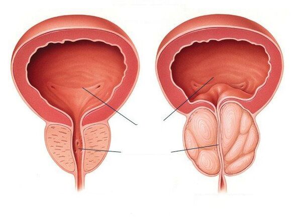 healthy and diseased prostates