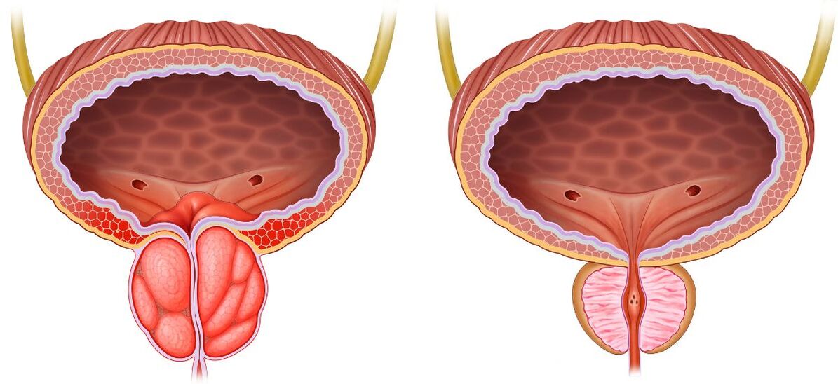 healthy and diseased prostates
